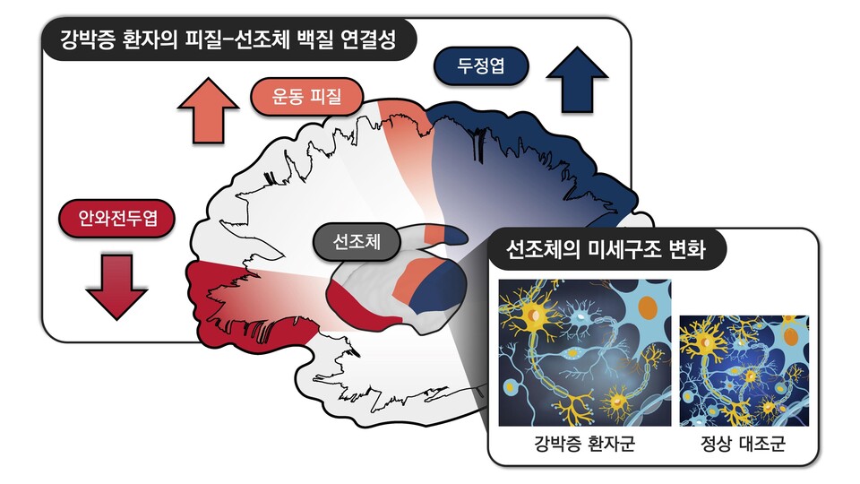 강박증, 뇌 속 선조체 회로가 원인? 강박증, 뇌 속 선조체 회로가 원인?