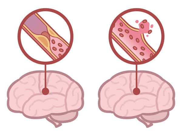 뇌졸중 (뇌경색(좌), 뇌출혈(우))<br>