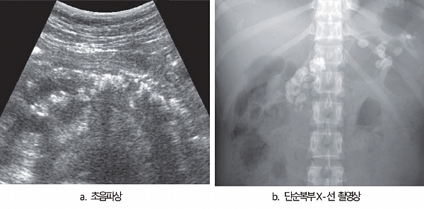 담도계·췌장 질환 초음파 감별 포인트