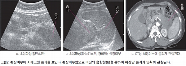 담도계·췌장 질환 초음파 감별 포인트
