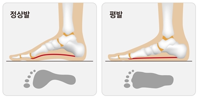 아기 평발 교정 진료 후기 (대구