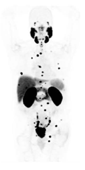 파일라리파 PET 영상&nbsp;<br>