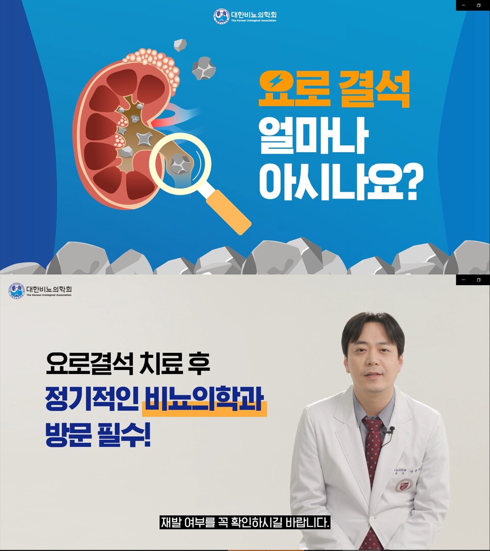 대한비뇨의학회, 요로결석 인식제고 위한 동영상 공개