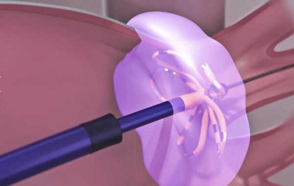 <strong>파라펄스 PFA 적용 이미지&nbsp;</strong><br>