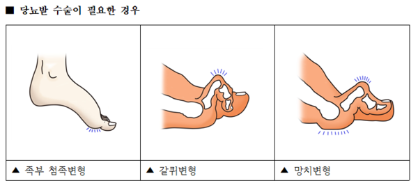 여름철 당뇨병 발 관리를 꼭 해야 하는 이유