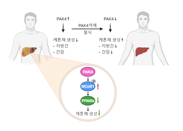 PAK4 단백질 억제에 의해 케톤체생성이 증가하여 지방간과 간암 완화