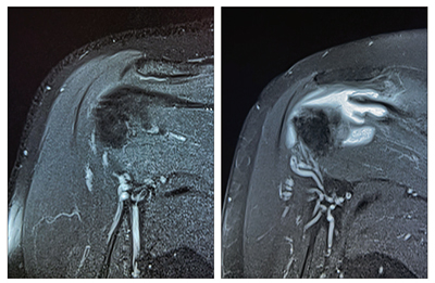 정상적인 상태의 회전근개(왼쪽)와 완전히 파열된 회전근개 이미지