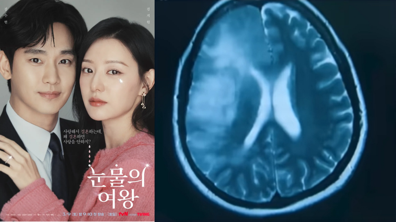 (왼쪽)드라마 '눈물의 여왕' 포스터와 극 중 홍해인(배우 김지원)의 뇌 MRI T2 사진.