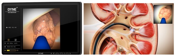 다인메디컬그룹의 요관내시경을 통한 인체 내부의 시술 장면