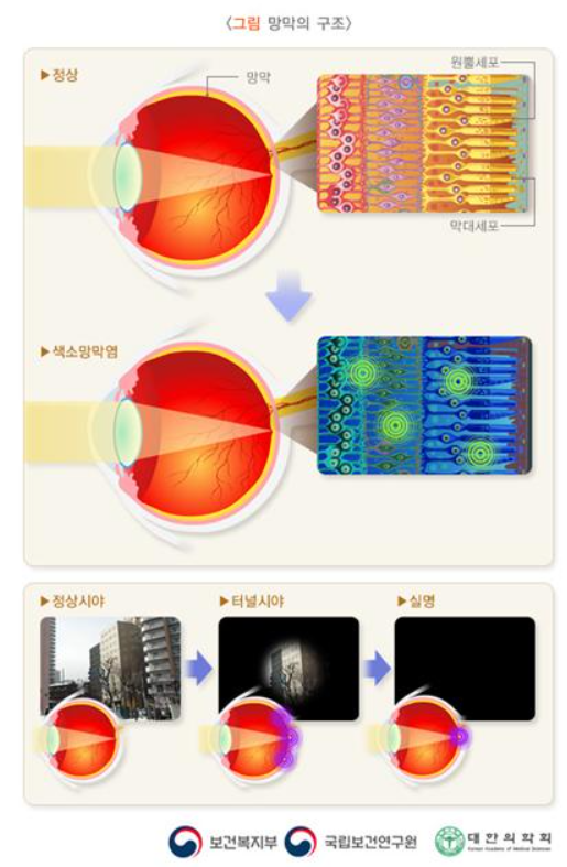 출처: 희귀질환 헬프라인