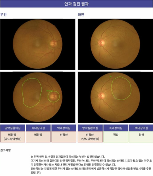 ‘닥터눈’을 이용한 검진결과.<br>