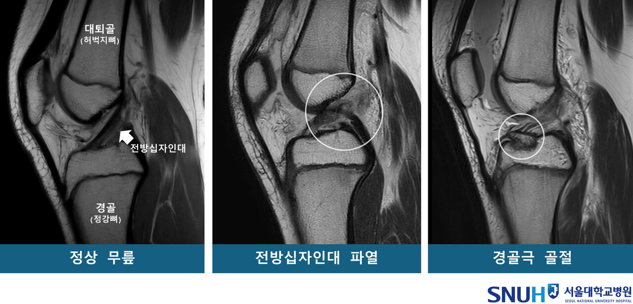 정상 무릎 및 무릎 부상 환자의 MRI(자료: 서울대병원)
