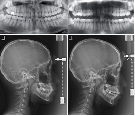 &lt;위,왼쪽부터&gt;‘셀프 치아장치’ 로 인한 교합변화, &lt;아래, 왼쪽부터&gt;턱관절 장애 부정교합 부작용 유발 사례<br>(사진제공: 대한치과의사협회)&nbsp;