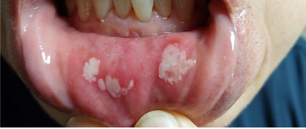 ‘셀프 치아장치’ 구매 고객에게 점막궤양이 유발된 사례(사진제공: 대한치과의사협회)&nbsp;