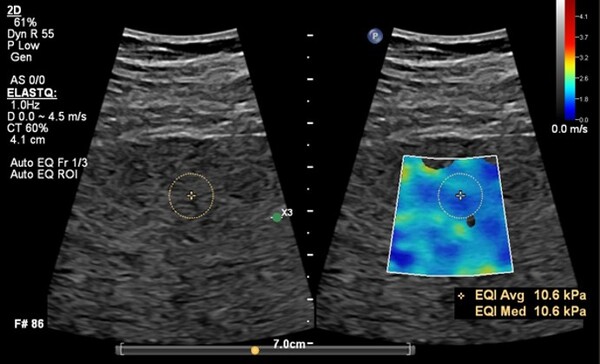 Philips Auto ElastQ – 자동으로 최적의 프레임을 찾아ROI를 최적의 위치에 배치<br>