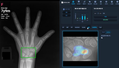 AI 기반 골연령 분석 소프트웨어 ‘MediAI-BA’